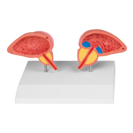 Modèle de prostate, 2 parties