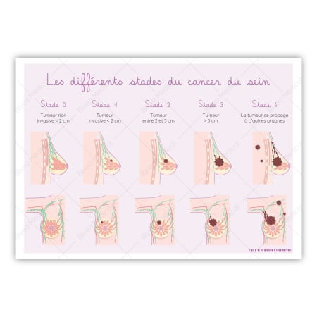 Schéma détaillant les différents stades d'un cancer du sein