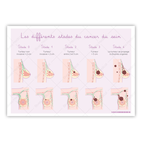 Schéma détaillant les différents stades d'un cancer du sein