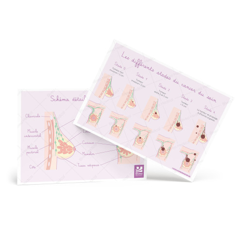 Carte différents stades du cancer du sein et schémas détaillés du sein