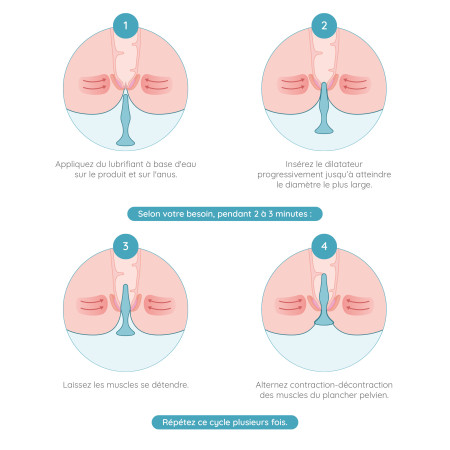 utilisation dilatateur anal