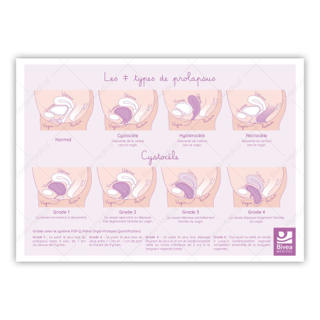 illustration recto des prolapsus : cystocèle, hystérocèle, rectocèle sur fond blanc