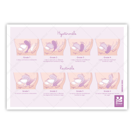 illustration verso des prolapsus : cystocèle, hystérocèle, rectocèle sur fond blanc