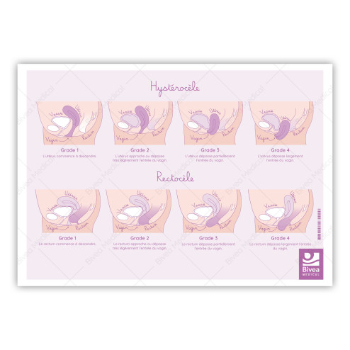 illustration verso des prolapsus : cystocèle, hystérocèle, rectocèle sur fond blanc