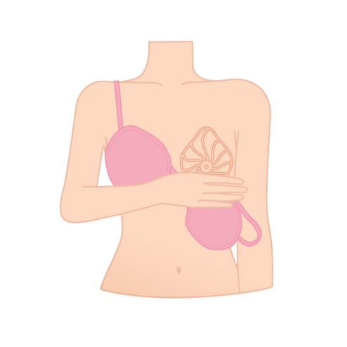 Prothèse mammaire externe portée dans une brassière post-opératoire