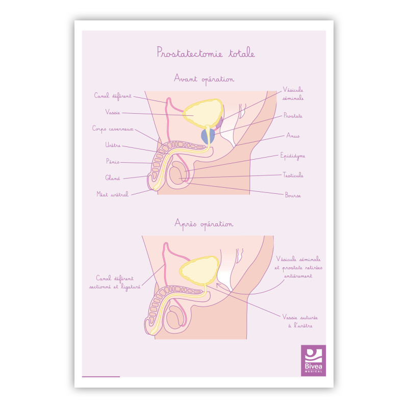 Illustration Prostatectomie totale