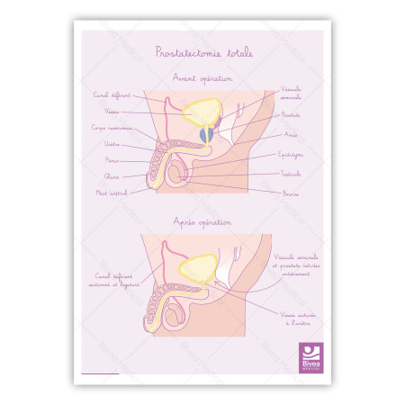 Illustration Prostatectomie totale