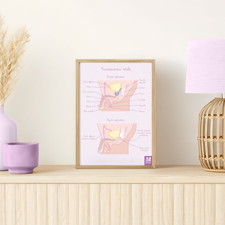 Illustration Prostatectomie totale