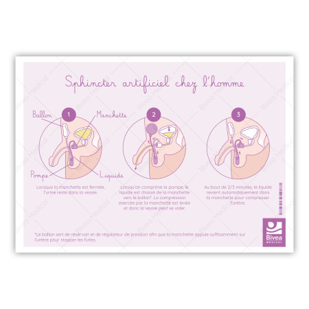 schéma utilisation sphincter artificiel chez l'homme