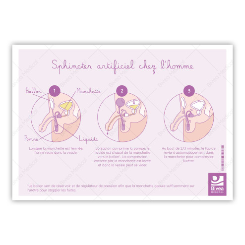 schéma utilisation sphincter artificiel chez l'homme