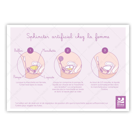 schéma utilisation sphincter artificiel chez la femme