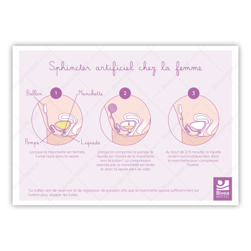 schéma utilisation sphincter artificiel chez la femme