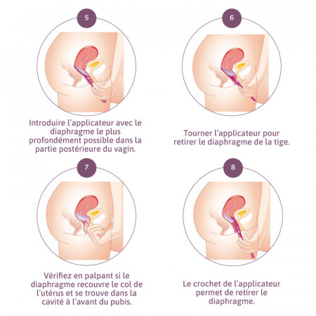 Comment utiliser l'applicateur pour diaphragme contraceptif