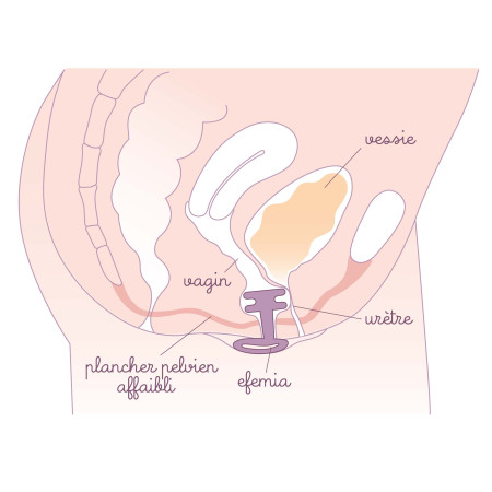 Utilisation du pessaire pour incontinence urinaire Efemia