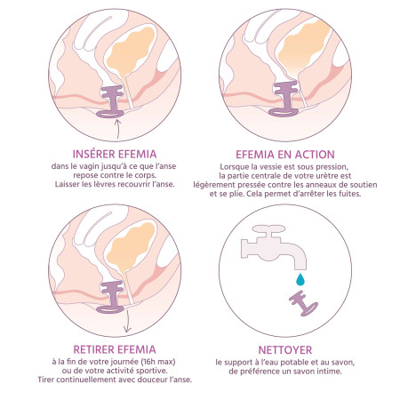 Utilisation détaillée du pessaire pour incontinence urinaire Efemia