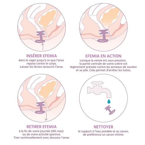 Utilisation détaillée du pessaire pour incontinence urinaire Efemia