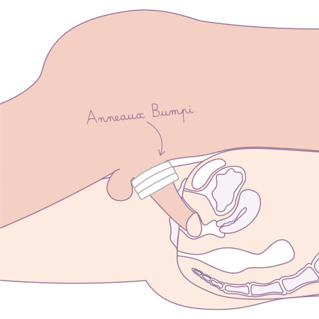 schéma utilisation rapports douloureux anneaux péniens bumpi