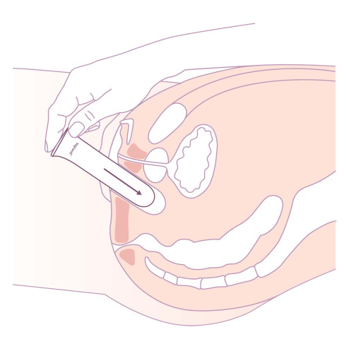 Schéma dilatateur vaginoplastie
