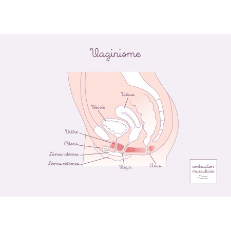 Carte anatomique Vaginisme