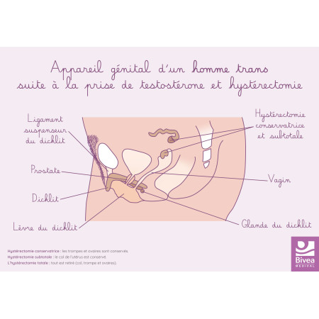 Carte appareil génital homme trans suite prise testostérone et hystérectomie