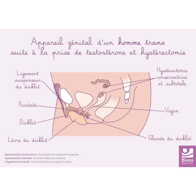 Carte appareil génital homme trans suite prise testostérone et hystérectomie