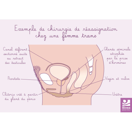 Carte anatomique Réassignation chez une femme trans