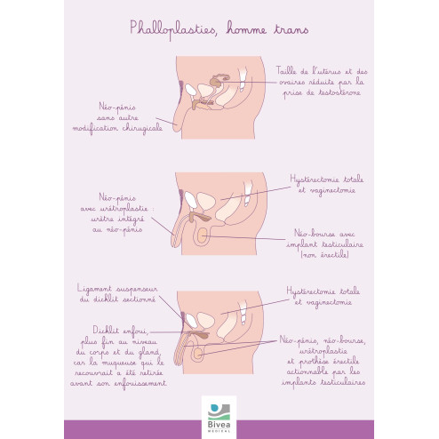 Poster A4 Phalloplasties homme trans