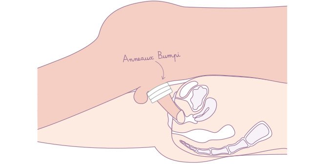 Utilisation lors de rapports douloureux d'anneaux péniens Bumpi