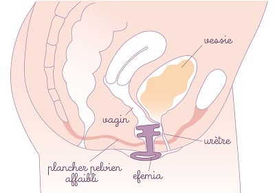 Placement efemia dans le vagin