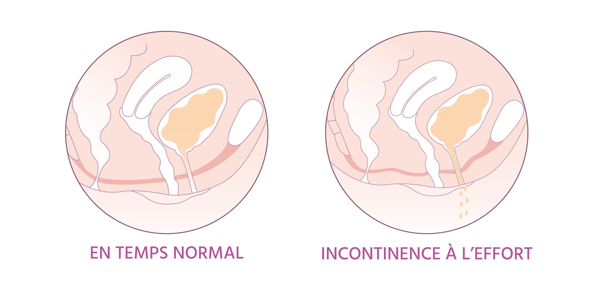 explications incontinence à l'effort