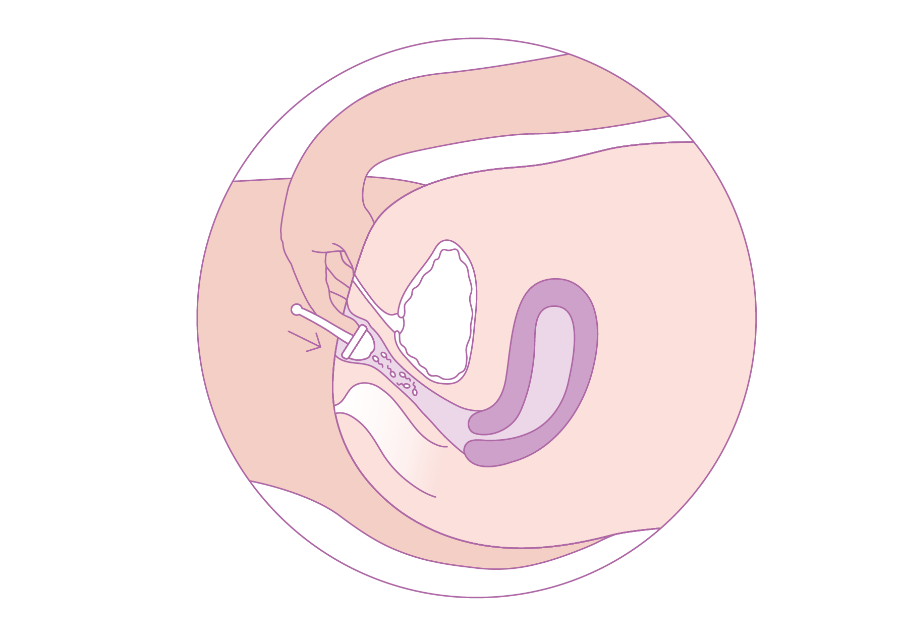 Ferti-Lily Placement coupe.png