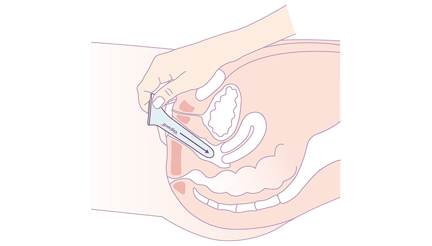 utilisation dilatateurs vaginaux