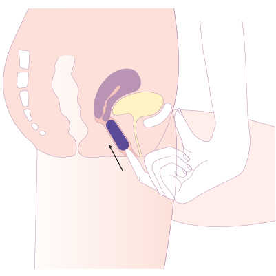 Placement Trackle